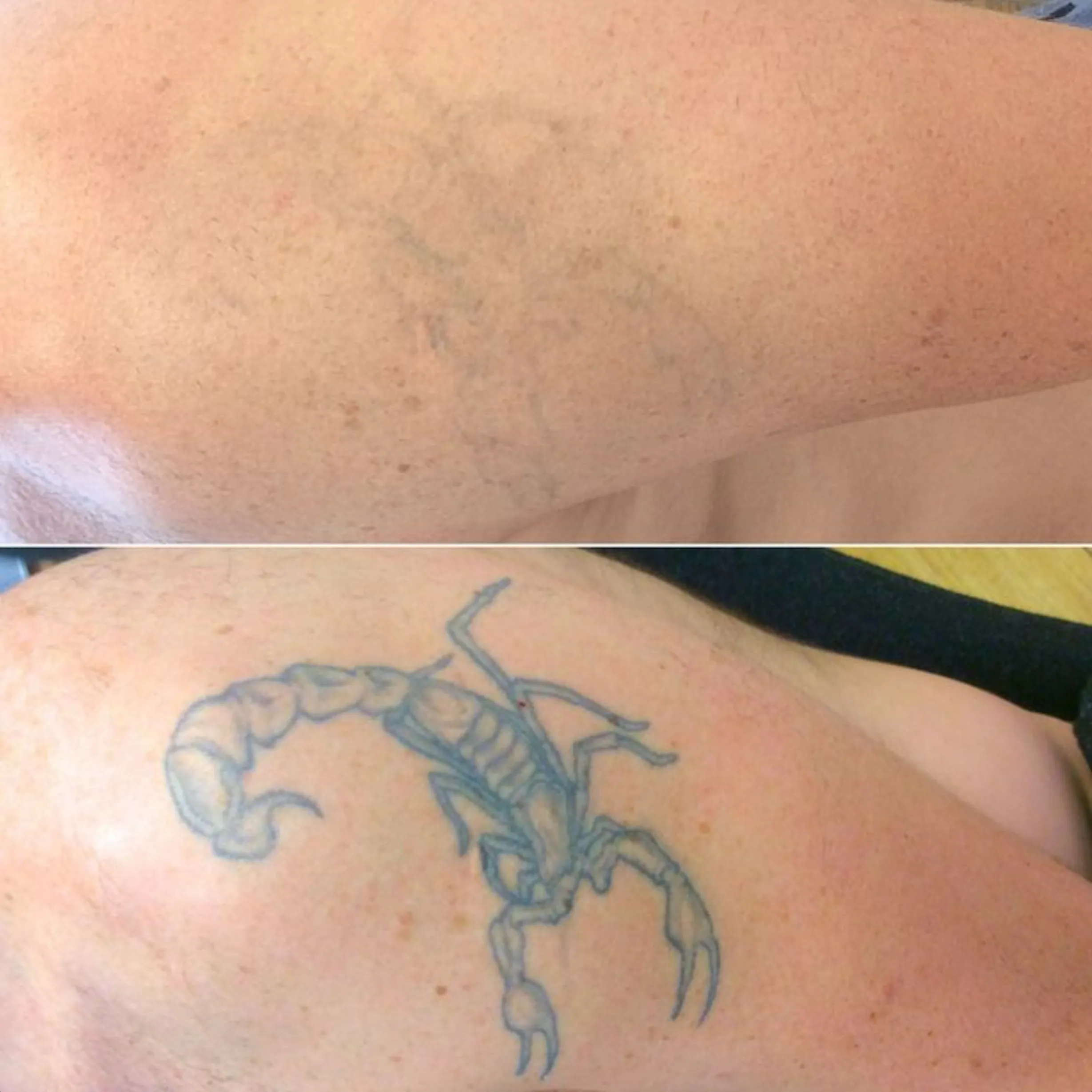 eyebrow tattoo removal Brisbane