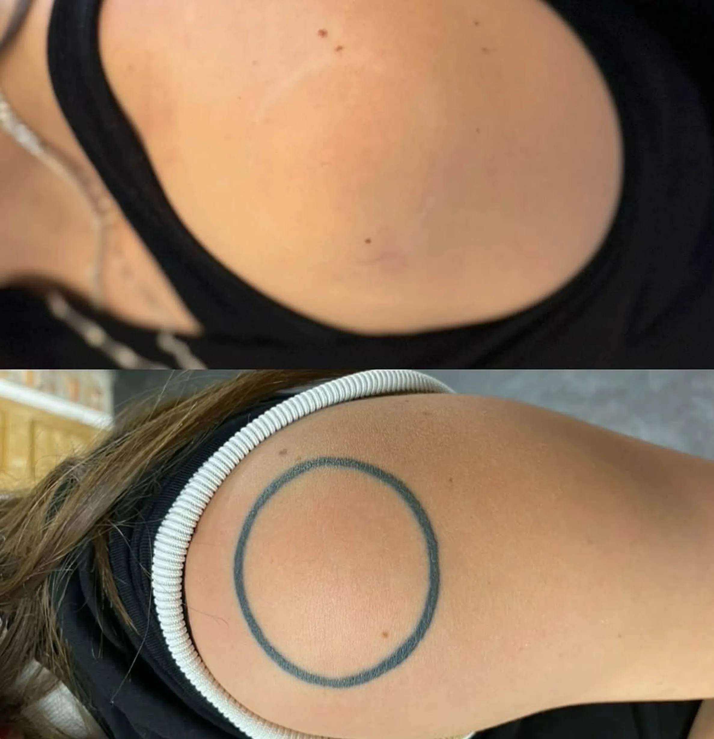 laser vs DIY tattoo removal