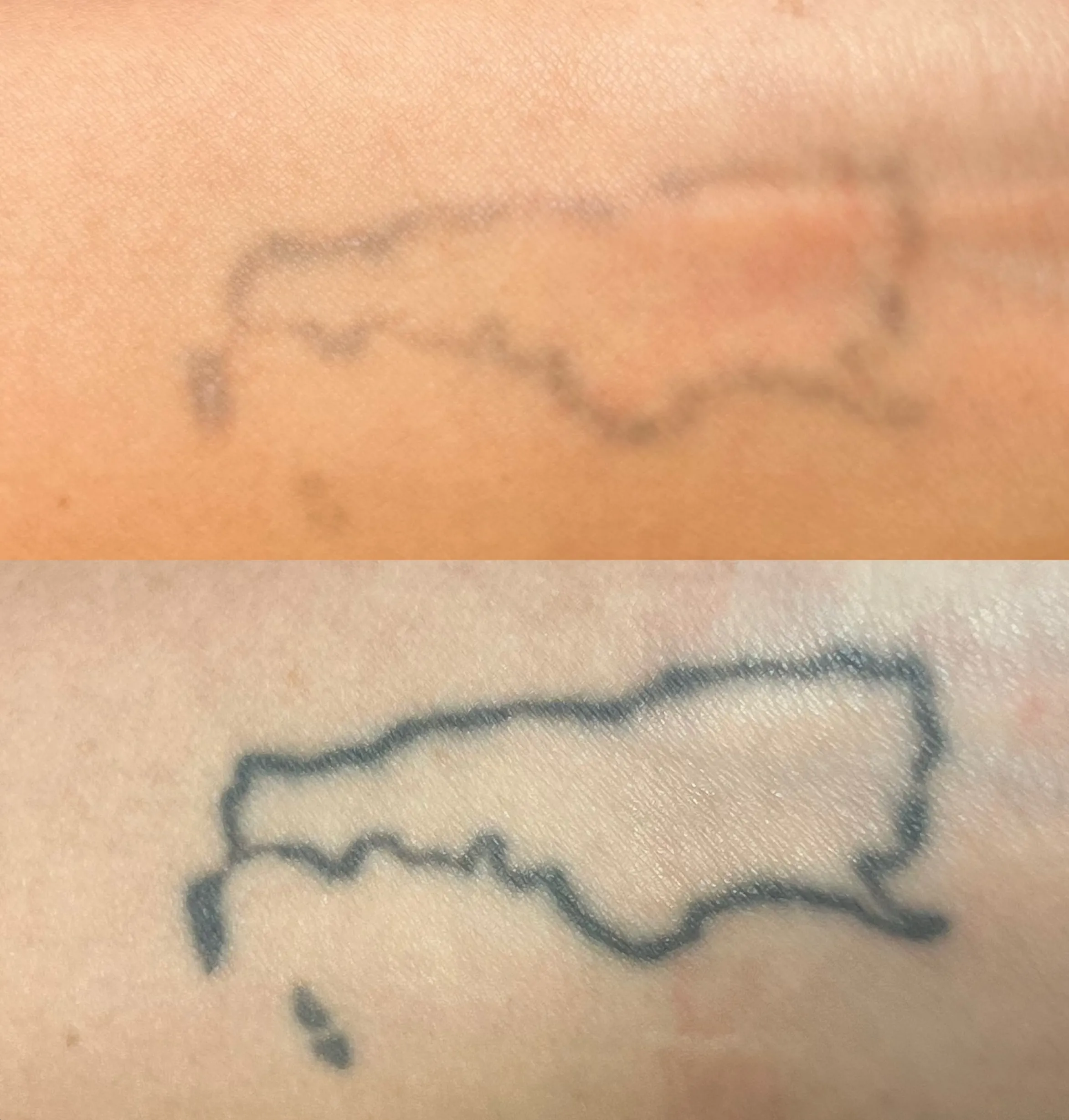 lemon juice tattoo removal myth