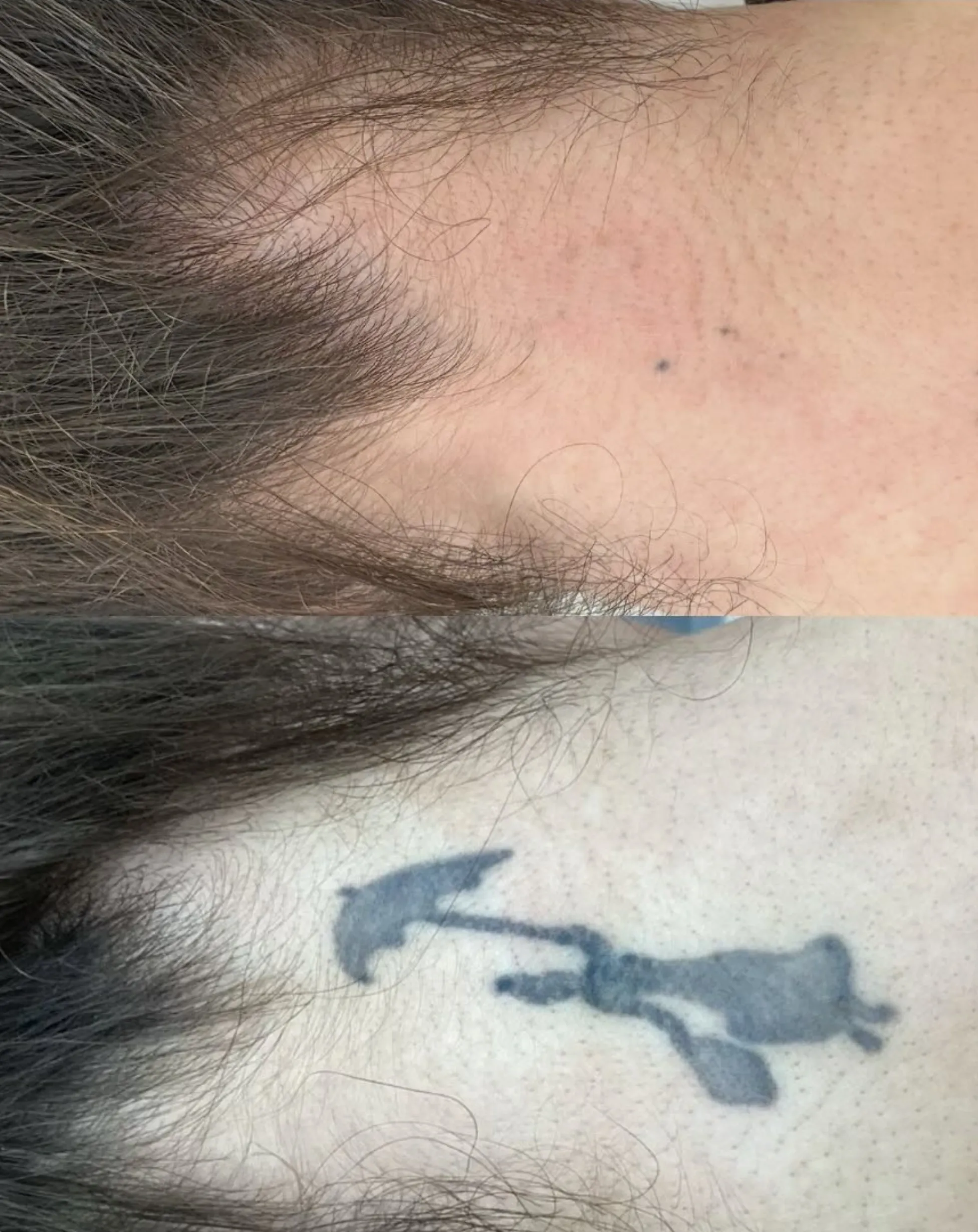 DIY tattoo removal risks
