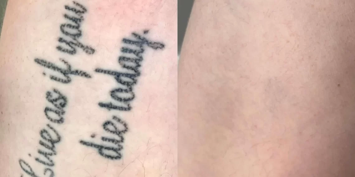 how to remove a tattoo at home